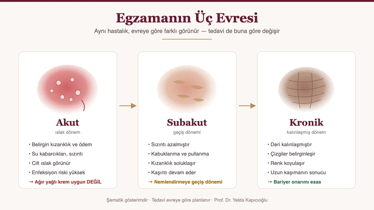 Egzamanın akut, subakut ve kronik evreleri şeması - Prof. Dr. Yelda Kapıcıoğlu